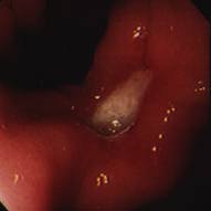 胃カメラで発見された胃潰瘍  